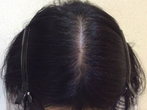 After(3ヶ月後)